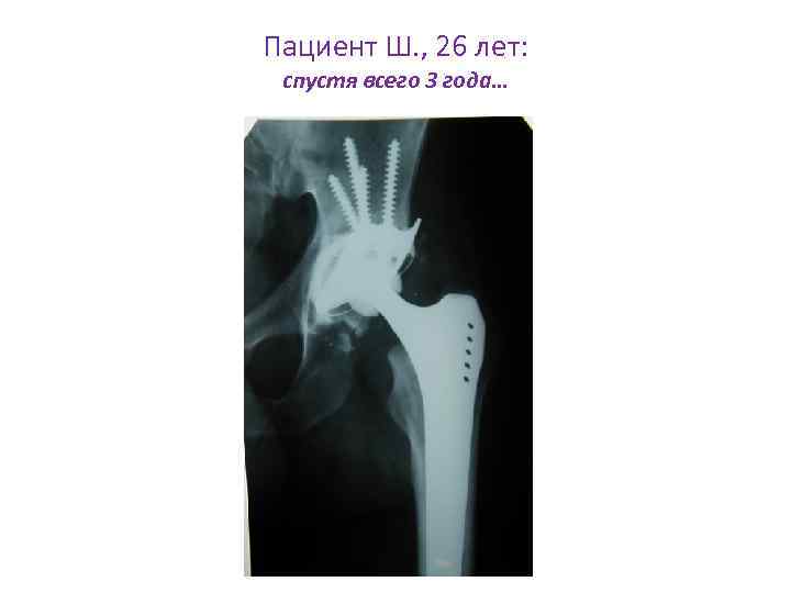 Пациент Ш. , 26 лет: спустя всего 3 года… 