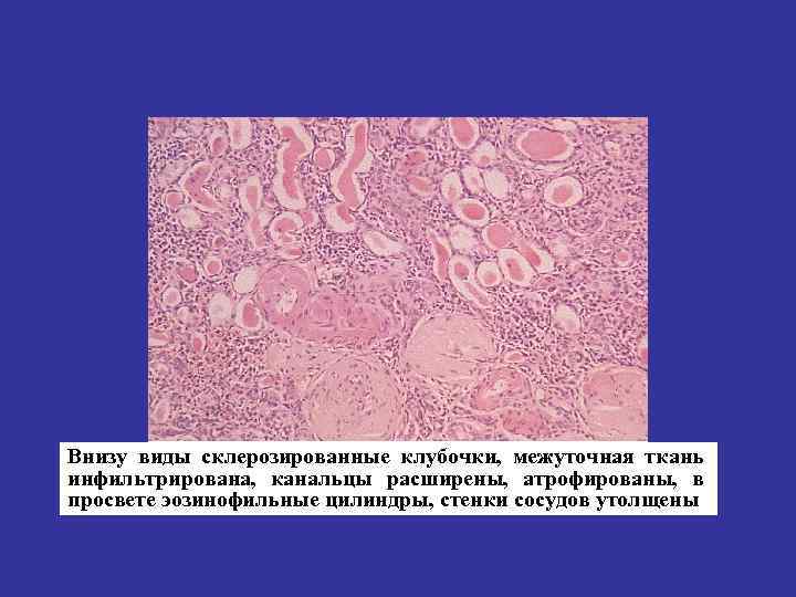 Внизу виды склерозированные клубочки, межуточная ткань инфильтрирована, канальцы расширены, атрофированы, в просвете эозинофильные цилиндры,