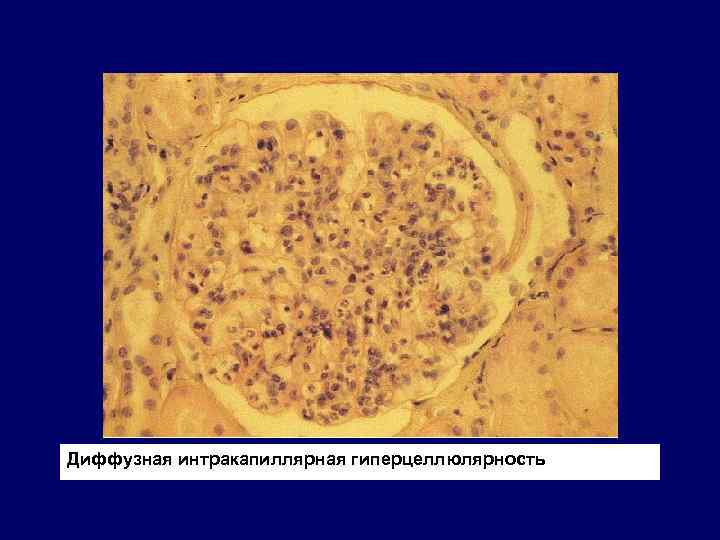 Диффузная интракапиллярная гиперцеллюлярность 