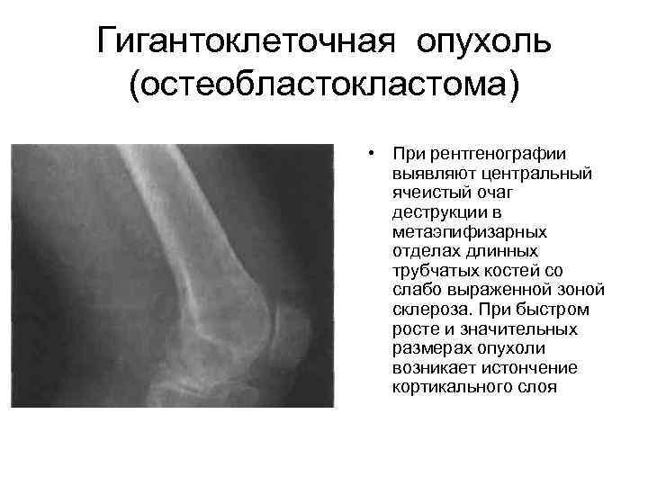 Злокачественные опухоли костей презентация