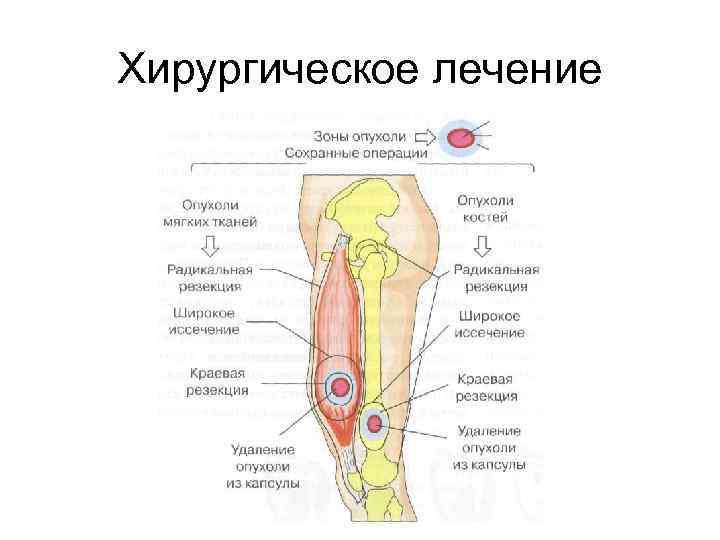 Опухоли костей презентация