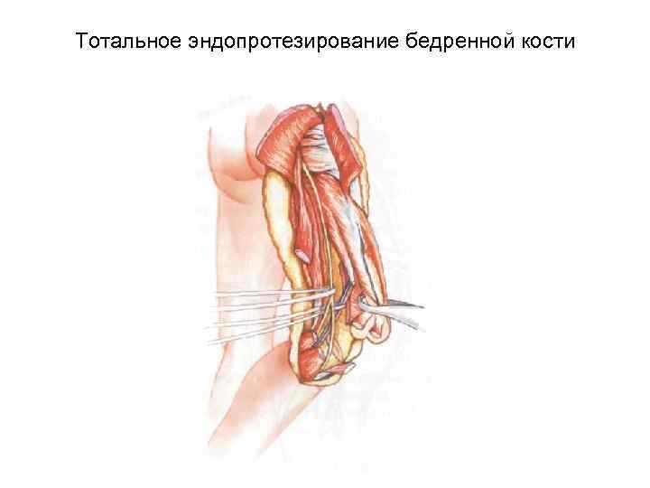 Тотальное эндопротезирование бедренной кости 