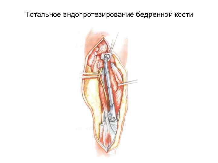 Тотальное эндопротезирование бедренной кости 