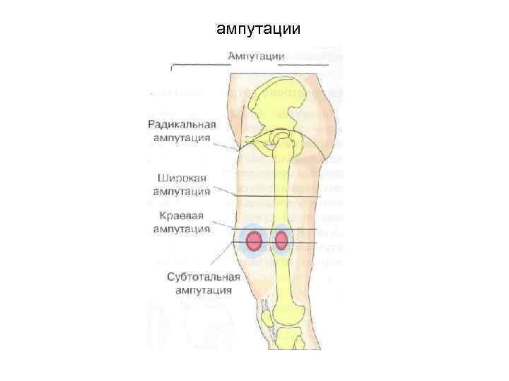 ампутации 