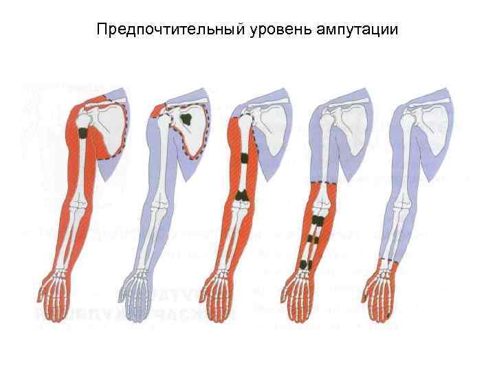 Предпочтительный уровень ампутации 