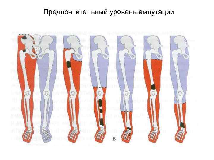 Предпочтительный уровень ампутации 