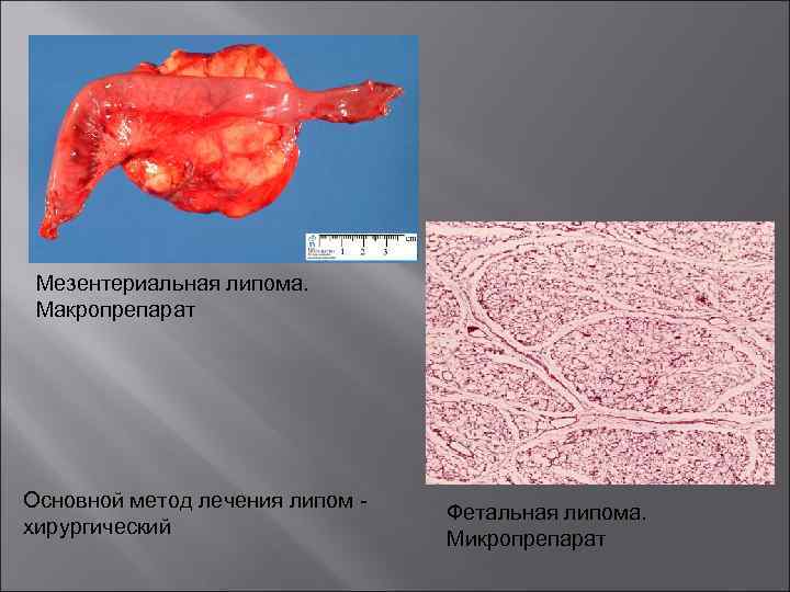 Мезентериальная липома. Макропрепарат Основной метод лечения липом хирургический Фетальная липома. Микропрепарат 