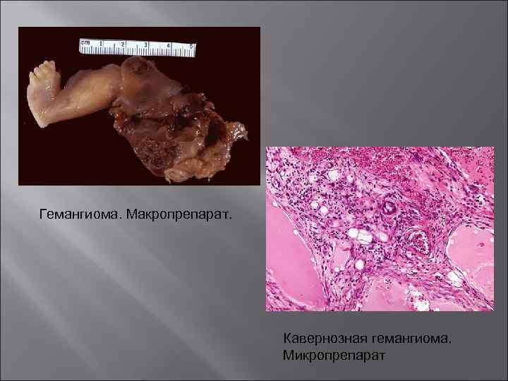 Гемангиома. Макропрепарат. Кавернозная гемангиома. Микропрепарат 