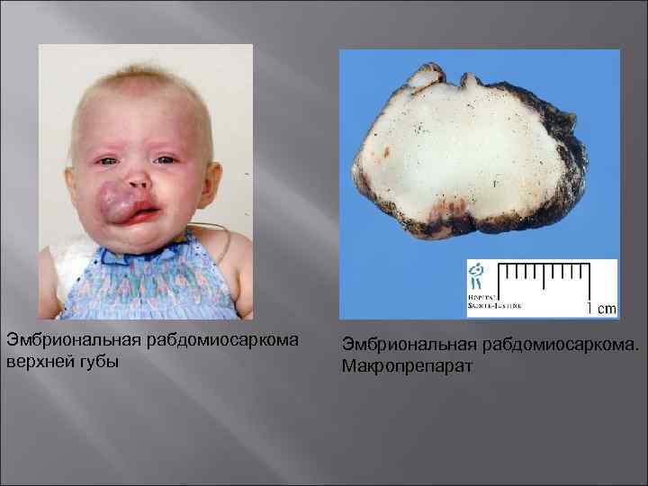 Эмбриональная рабдомиосаркома верхней губы Эмбриональная рабдомиосаркома. Макропрепарат 