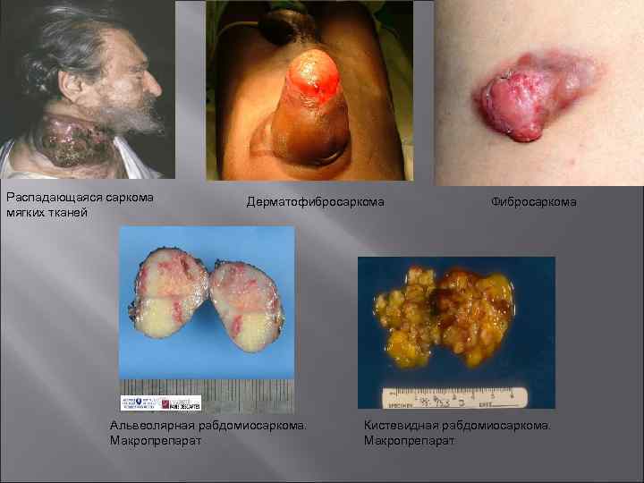 Распадающаяся саркома мягких тканей Дерматофибросаркома Альвеолярная рабдомиосаркома. Макропрепарат Фибросаркома Кистевидная рабдомиосаркома. Макропрепарат 