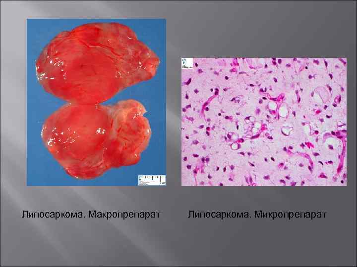 Липосаркома. Макропрепарат Липосаркома. Микропрепарат 