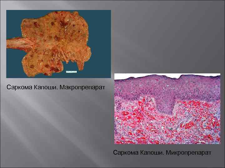 Саркома капоши кожи фото