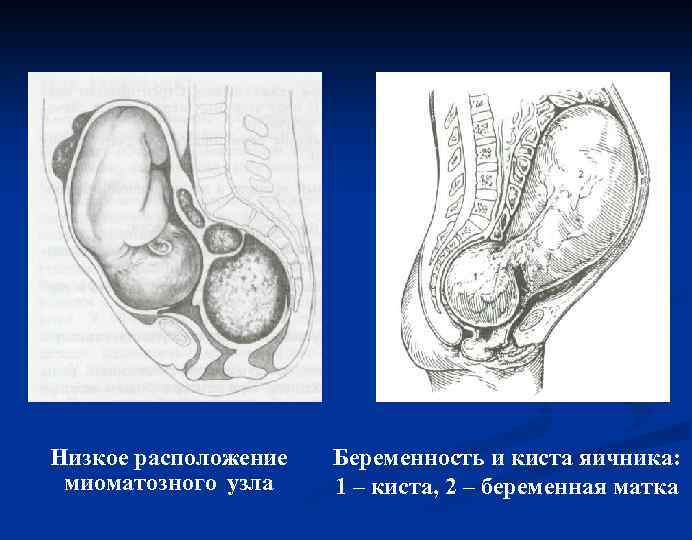 Низкое расположение миоматозного узла Беременность и киста яичника: 1 – киста, 2 – беременная