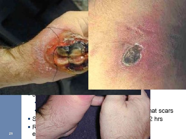 Brown Recluse – Clinical Signs 25 § 2 -8 hours • Local reaction with