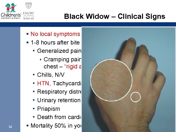 Black Widow – Clinical Signs 32 § No local symptoms § 1 -8 hours