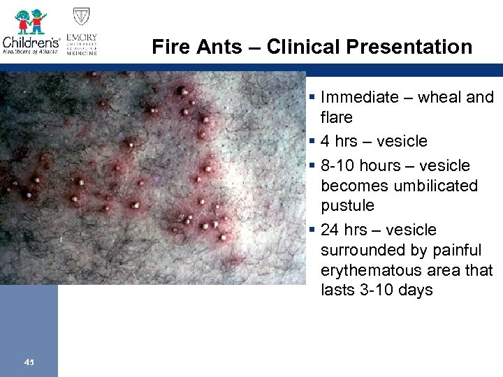 Fire Ants – Clinical Presentation § Immediate – wheal and flare § 4 hrs