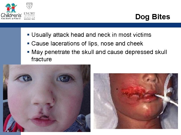 Dog Bites § Usually attack head and neck in most victims § Cause lacerations