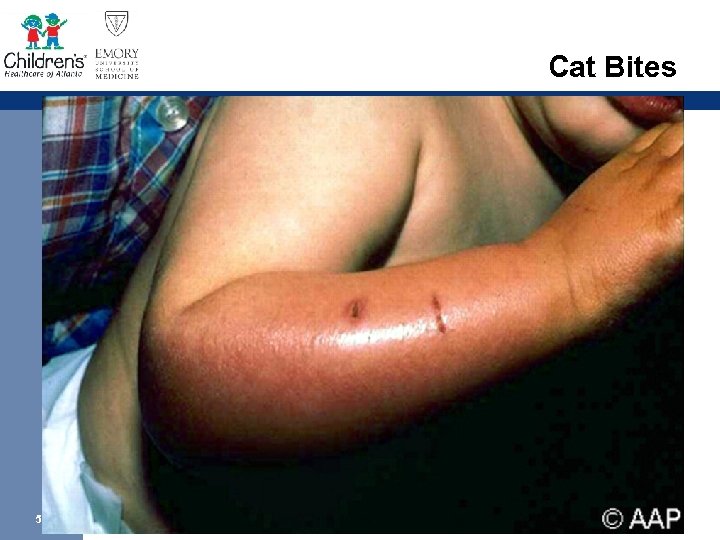 Cat Bites 50 § Usually attack upper extremities § Pasturella infections are very aggressive