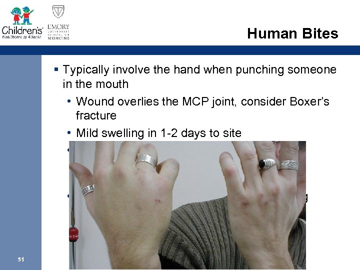 Human Bites § Typically involve the hand when punching someone in the mouth •