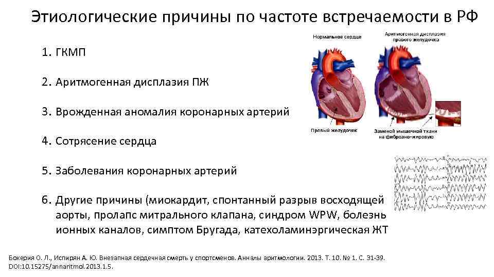 Этиологические причины по частоте встречаемости в РФ 1. ГКМП 2. Аритмогенная дисплазия ПЖ 3.