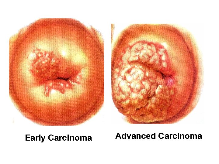 Early Carcinoma Advanced Carcinoma 