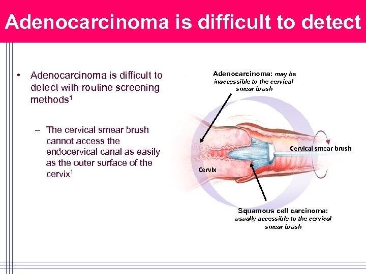 Adenocarcinoma is difficult to detect • Adenocarcinoma is difficult to detect with routine screening