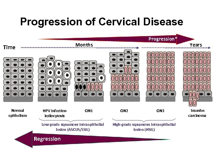Progression of Cervical Disease Months Time Normal epithelium Progression* HPV infection koilocytosis CIN 1