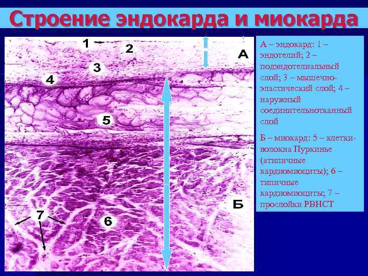 Строение эндокарда и миокарда А – эндокард: 1 – эндотелий; 2 – подэндотелиальный слой;