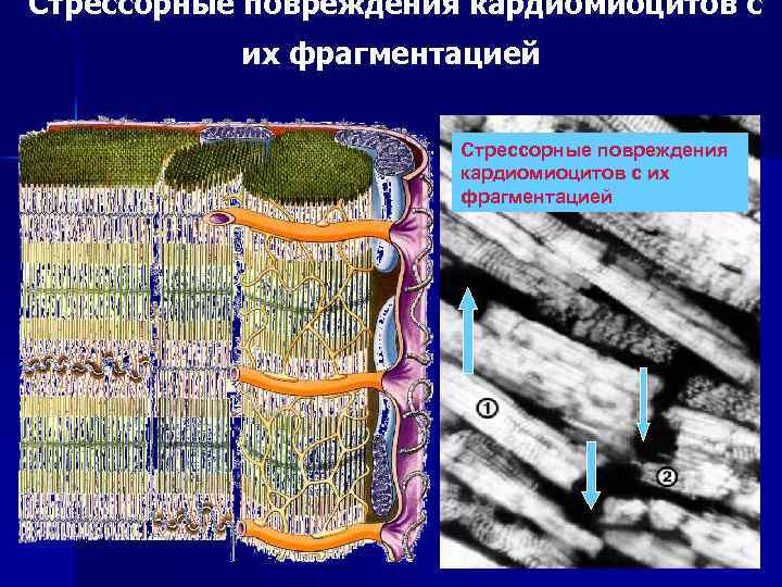 Стрессорные повреждения кардиомиоцитов с их фрагментацией 