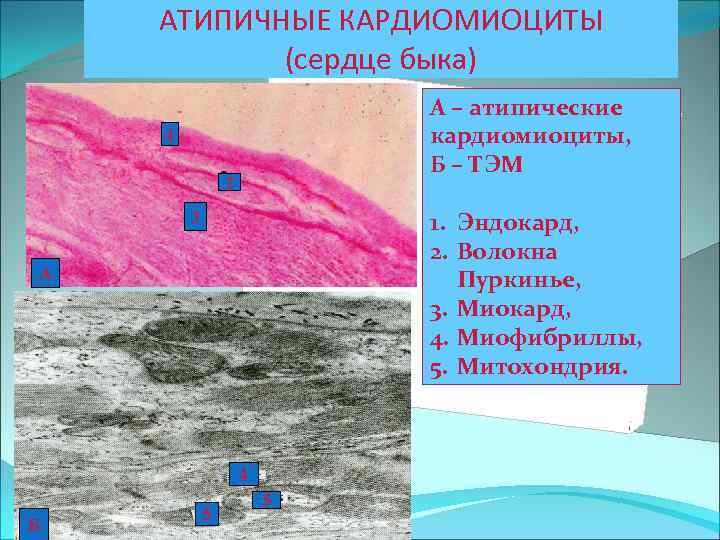 Атипичные кардиомиоциты рисунок