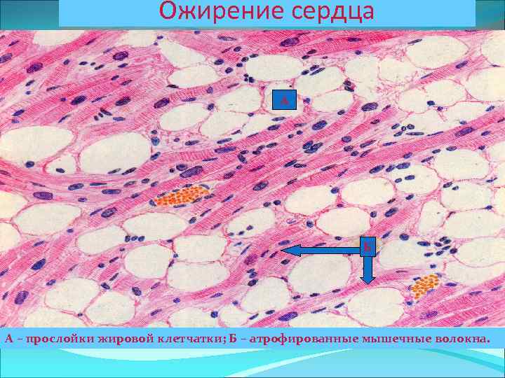 Ожирение сердца А Б А – прослойки жировой клетчатки; Б – атрофированные мышечные волокна.