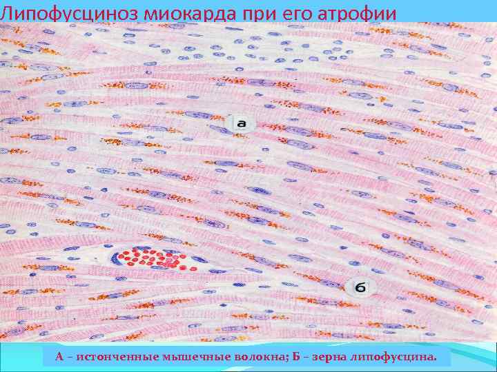 Липофусциноз миокарда при его атрофии А – истонченные мышечные волокна; Б – зерна липофусцина.