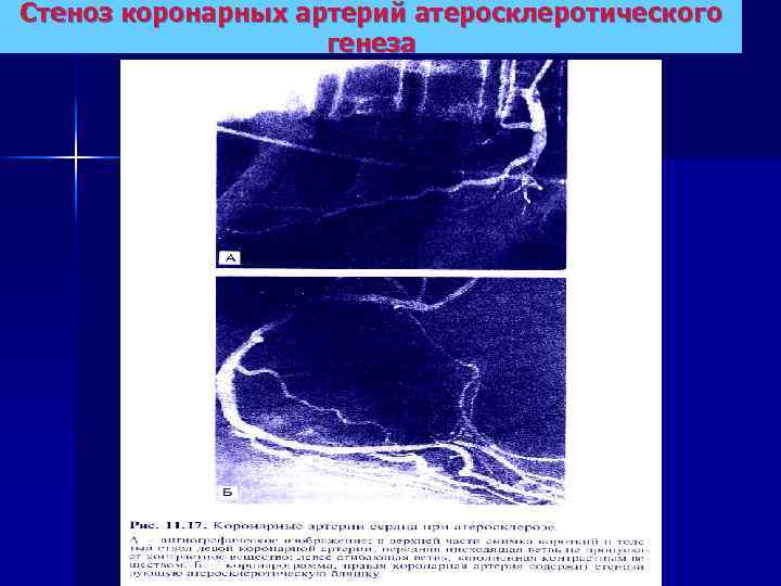 Стеноз коронарных артерий атеросклеротического генеза 