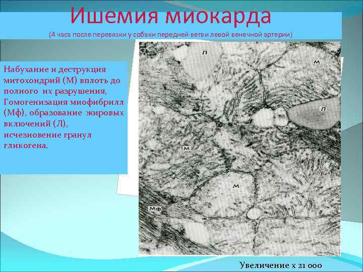 Ишемия миокарда (4 часа после перевязки у собаки передней ветви левой венечной артерии) Набухание