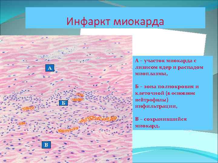 Инфаркт миокарда А – участок миокарда с лизисом ядер и распадом миоплазмы, А Б