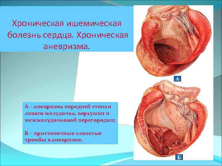 Хроническая ишемическая болезнь сердца. Хроническая аневризма. А А – аневризма передней стенки левого желудочка,