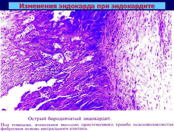 Изменения эндокарда при эндокардите 