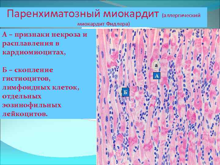 Паренхиматозный миокардит (аллергический миокардит Фидлера) А – признаки некроза и расплавления в кардиомиоцитах, Б