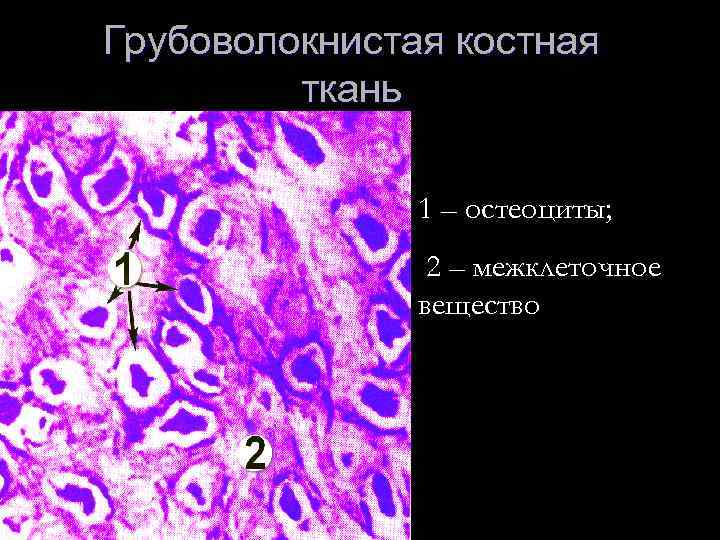 Грубоволокнистая костная ткань 1 – остеоциты; 2 – межклеточное вещество 