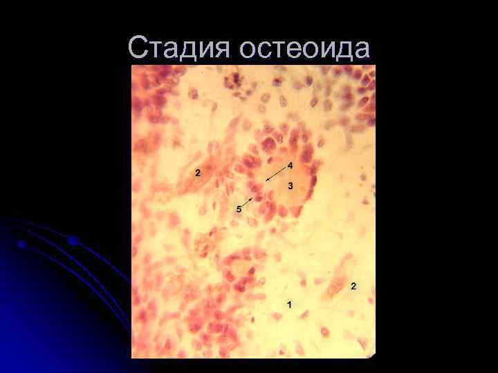 Стадия остеоида 