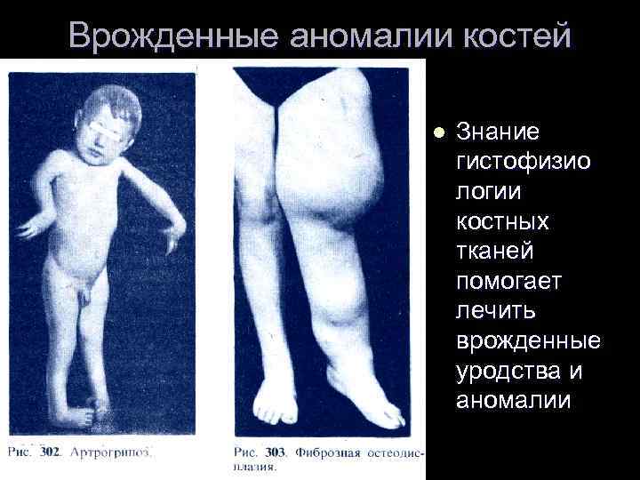 Врожденные аномалии костей l Знание гистофизио логии костных тканей помогает лечить врожденные уродства и