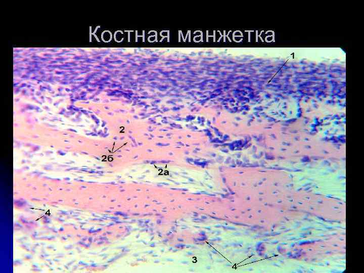 Костная манжетка 