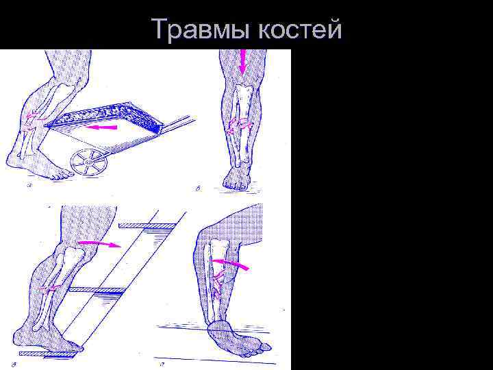 Травмы костей 