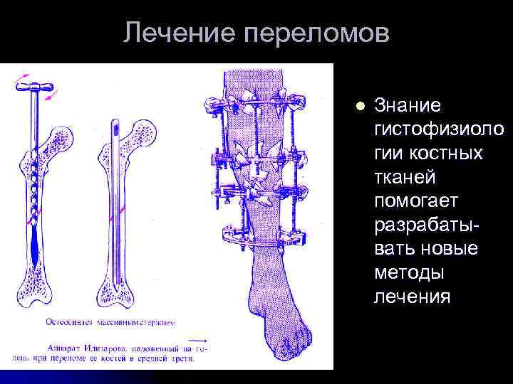 Лечение переломов l Знание гистофизиоло гии костных тканей помогает разрабатывать новые методы лечения 
