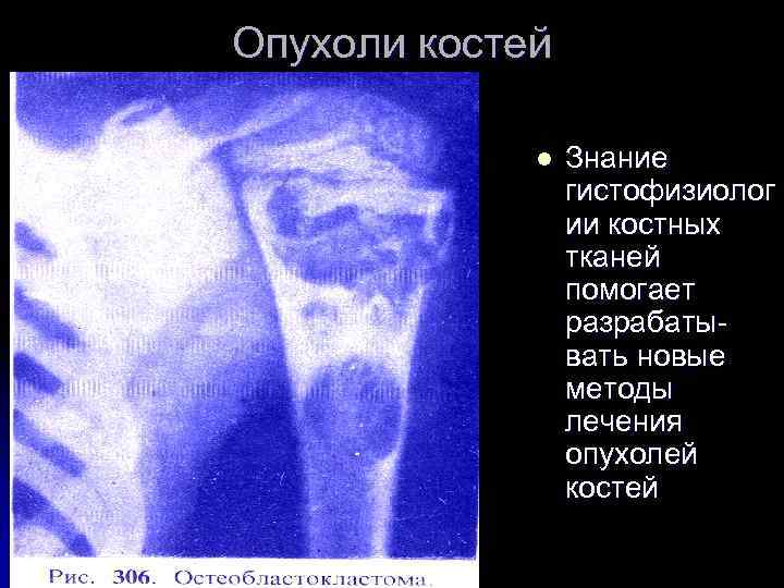 Опухоли костей l Знание гистофизиолог ии костных тканей помогает разрабатывать новые методы лечения опухолей