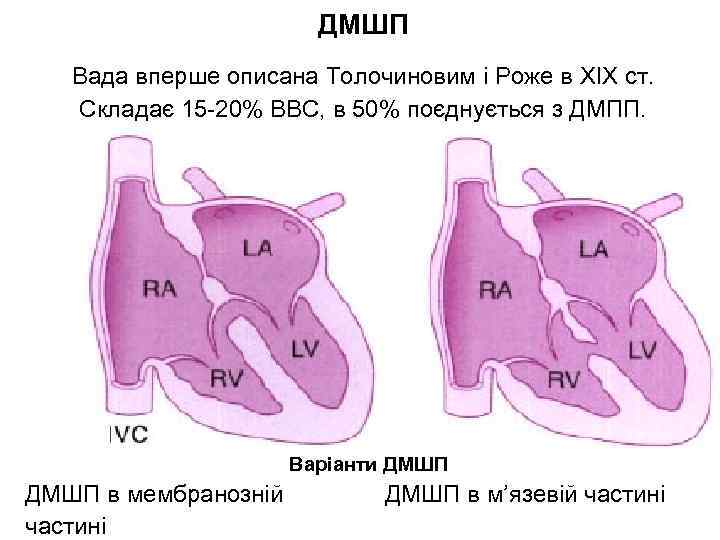 ДМШП Вада вперше описана Толочиновим і Роже в XIX ст. Складає 15 -20% ВВС,