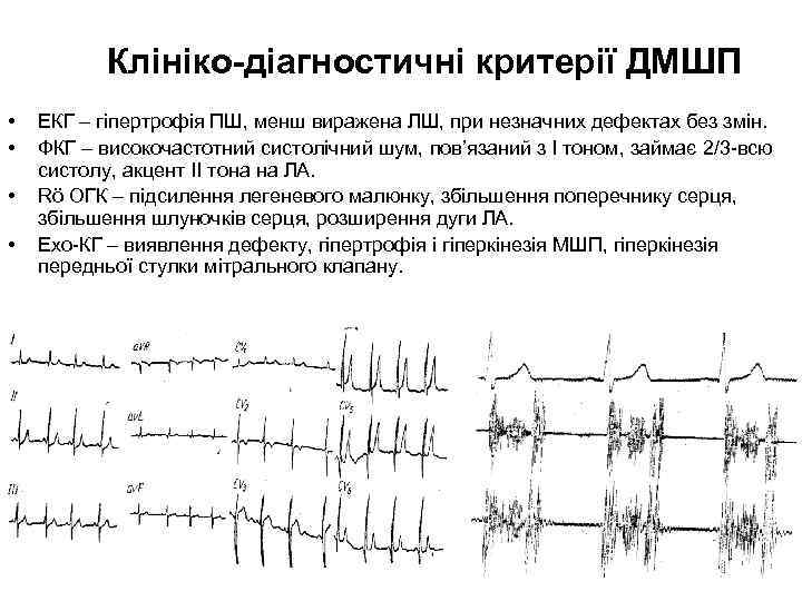 Клініко-діагностичні критерії ДМШП • • ЕКГ – гіпертрофія ПШ, менш виражена ЛШ, при незначних