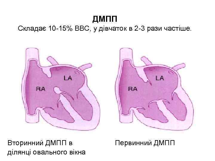 ДМПП Складає 10 -15% ВВС, у дівчаток в 2 -3 рази частіше. Вторинний ДМПП