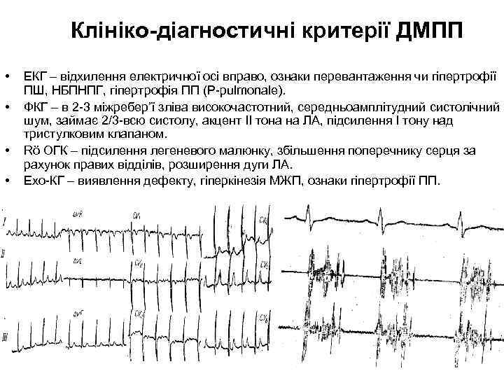 Клініко-діагностичні критерії ДМПП • • ЕКГ – відхилення електричної осі вправо, ознаки перевантаження чи