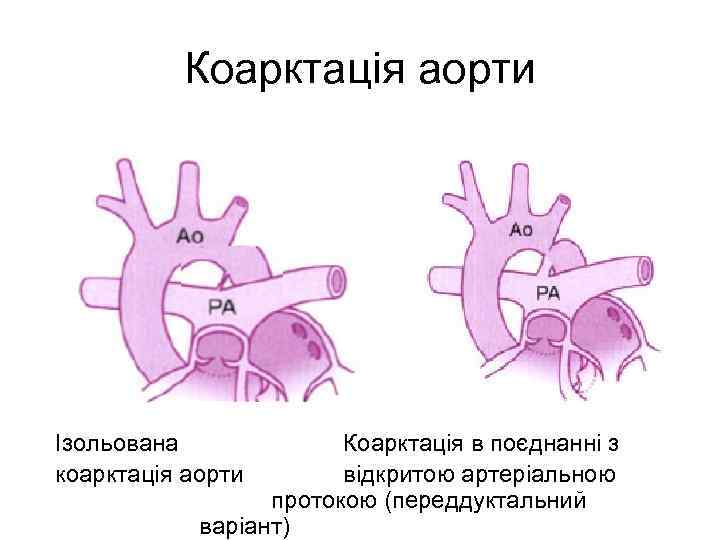 Коарктація аорти Ізольована коарктація аорти Коарктація в поєднанні з відкритою артеріальною протокою (переддуктальний варіант)